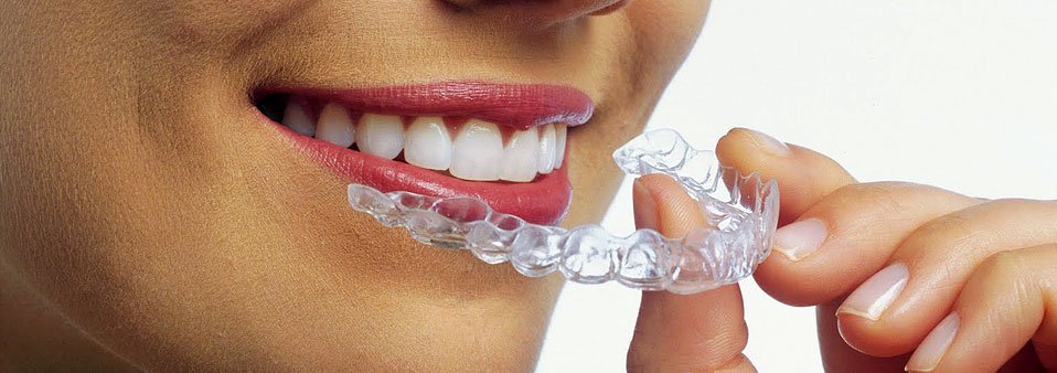 Clear Aligner Ortodoncia Sin Brackets Juan Carlos Estrada Ortodoncista